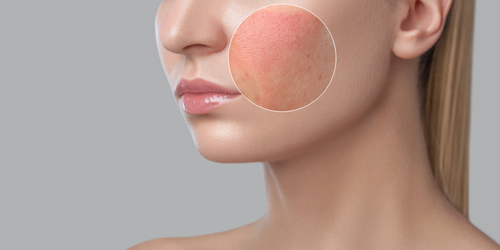 WHAT IS ROSACEA? AND HOW CAN COLLAGEN HELP?